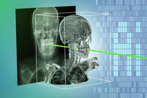 Kỹ thuật AI mới có thể giúp các ca phẫu thuật xâm lấn ở mức tối thiểu trở nên an toàn và chính xác hơn